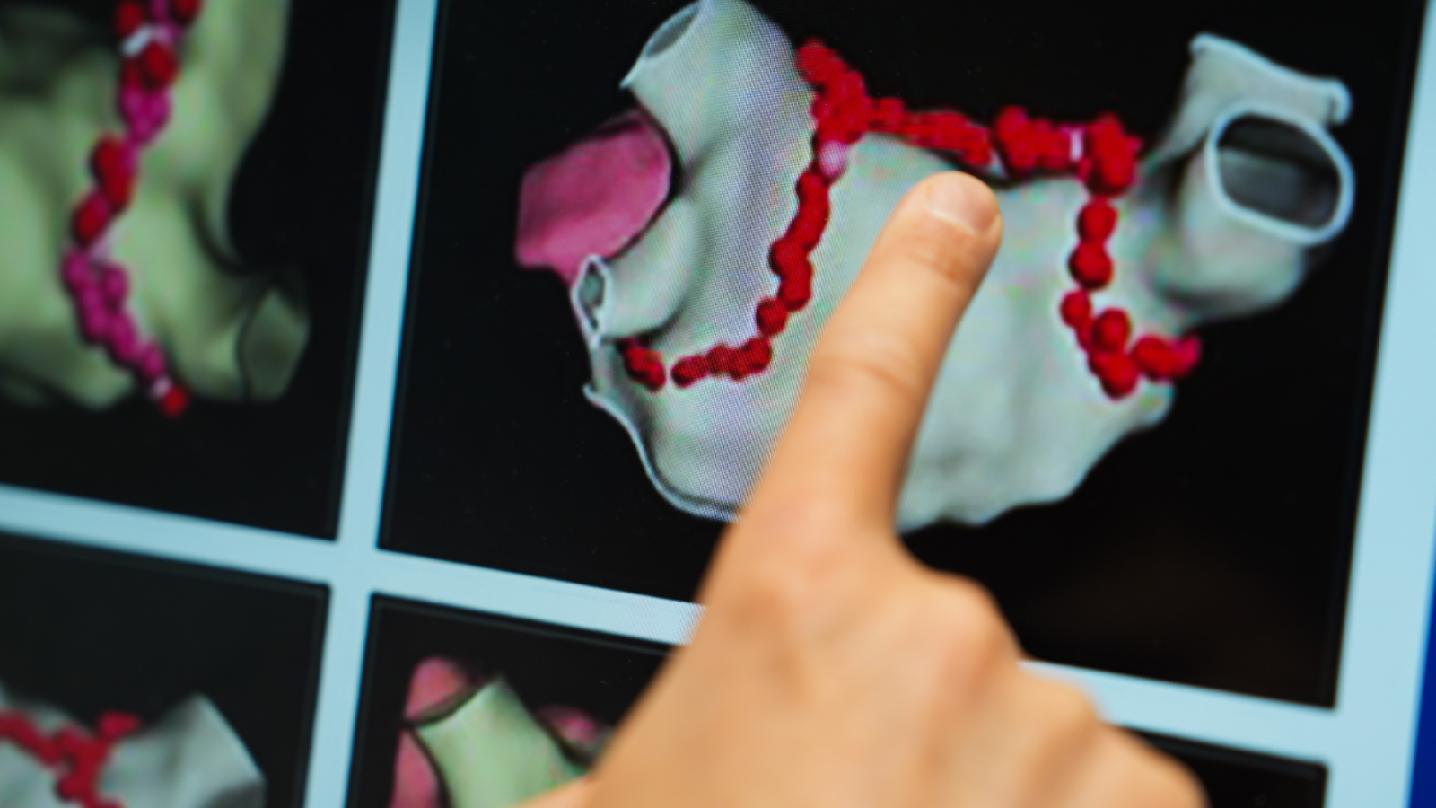 kardiyoloji uzmanindan kalp ritim bozukluklari icin ablasyon tedavisi onerisi cogu hasta ayni gun taburcu ediliyor 6OHx4nfr